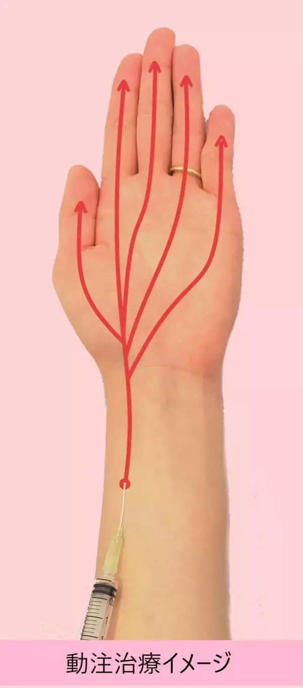 「治療法がないと言われた患者さんを慢性的な痛みから救いたい。痛みの原因「モヤモヤ血管」に注目した画期的な治療法『動注治療』を開発するまでのストーリー」の画像