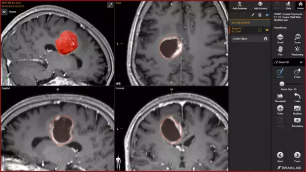 Brainlab(R) ElementsにAI技術を新たに搭載