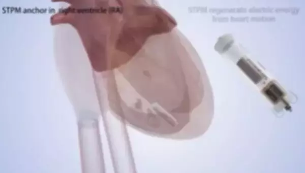 心臓の鼓動で自ら発電するペースメーカーの開発に成功―中国