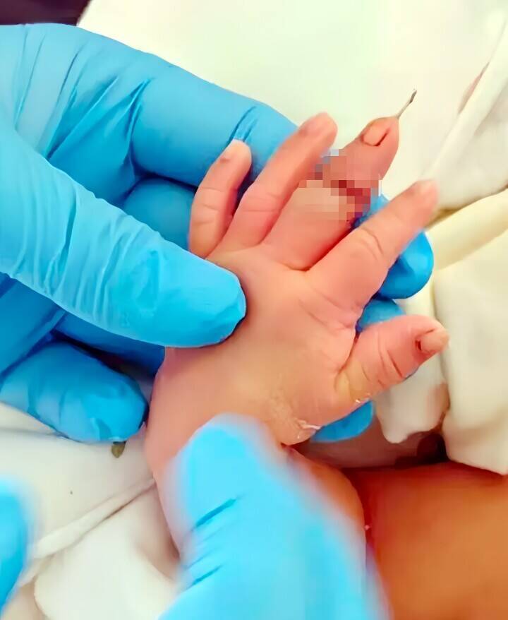 へその緒を切ろうとした助産師、誤って新生児の指を切り落とす＝「急に動いたから」―中国