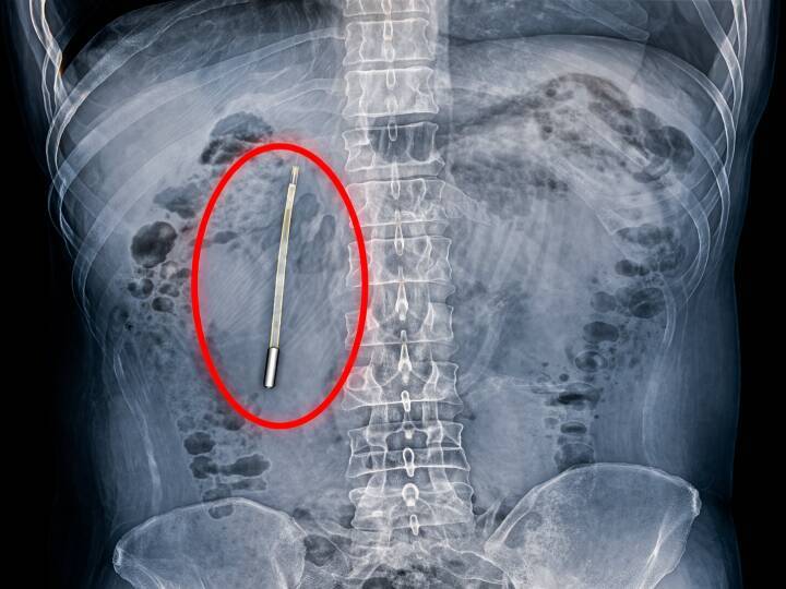 腹痛で病院に駆け込んだ男性、腸内から水銀体温計―中国