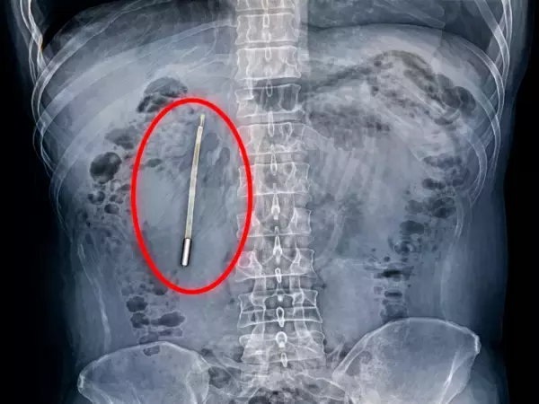 「腹痛で病院に駆け込んだ男性、腸内から水銀体温計―中国」の画像