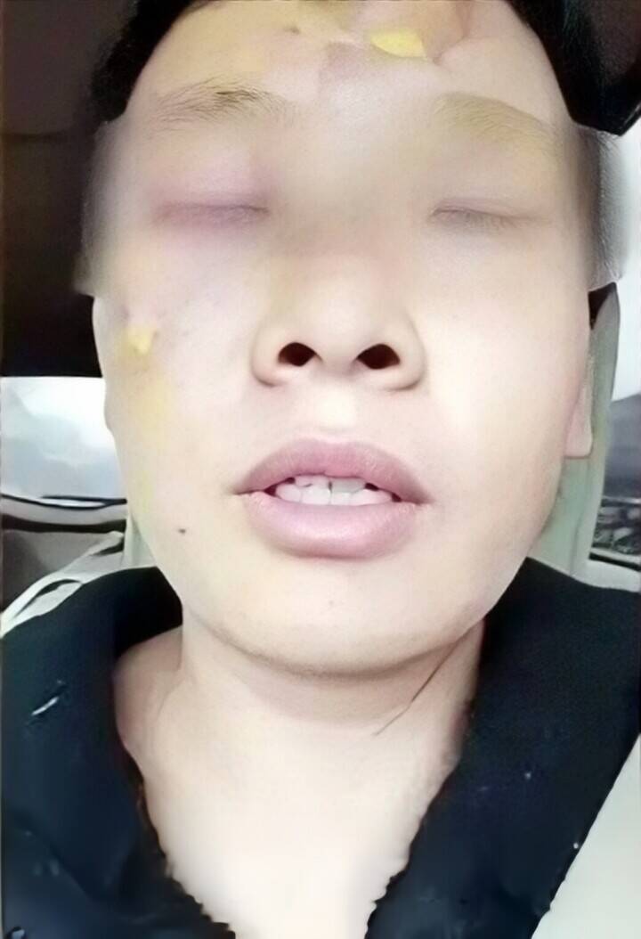 ネットで見たライフハックを試したらいきなり爆発、女性が顔に大やけど―中国