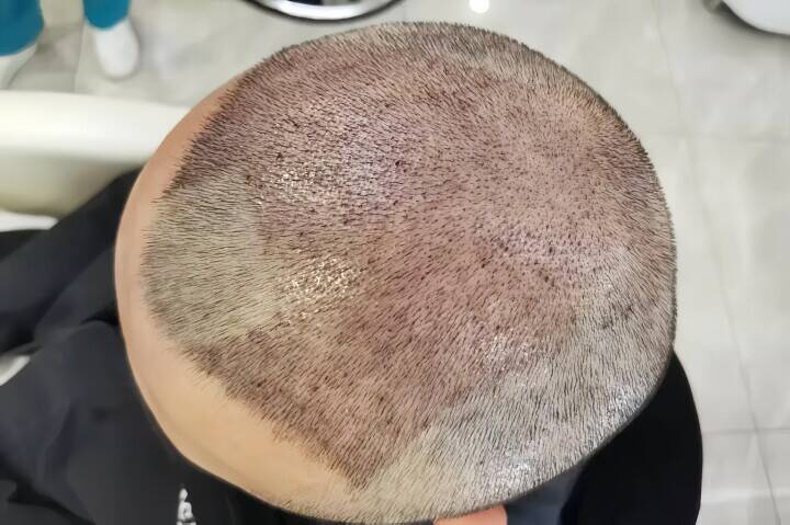 韓国は脱毛症治療の保険適用を検討、中国も「他人事」ではない―中国メディア