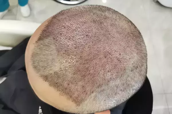 「韓国は脱毛症治療の保険適用を検討、中国も「他人事」ではない―中国メディア」の画像