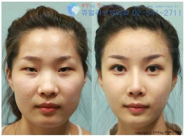 韓国の最新美容整形技術がすごい 手術後は完全に別人レベル 11年7月8日 エキサイトニュース