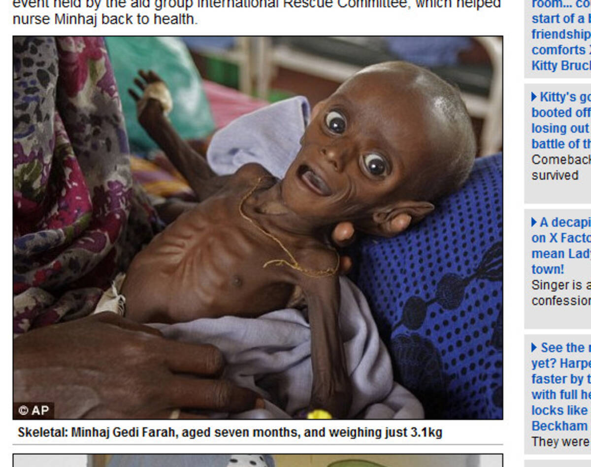 ガリガリだったソマリア難民の赤ちゃんがこんなに元気になりました 11年11月14日 エキサイトニュース