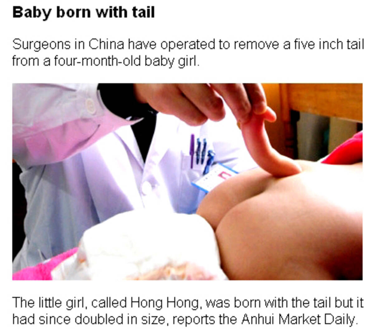 しっぽ の生えた赤ちゃん誕生 切除手術に成功 10年3月10日 エキサイトニュース
