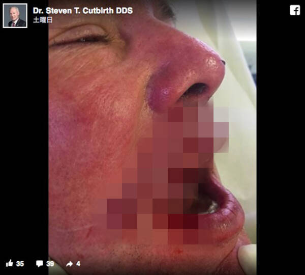 閲覧注意 サメに襲われた歯科医が生々しい傷口と体験談をfacebookで公開し多くの人を震え上がらす アメフト選手が突っ込んできたような衝撃 16年7月28日 エキサイトニュース