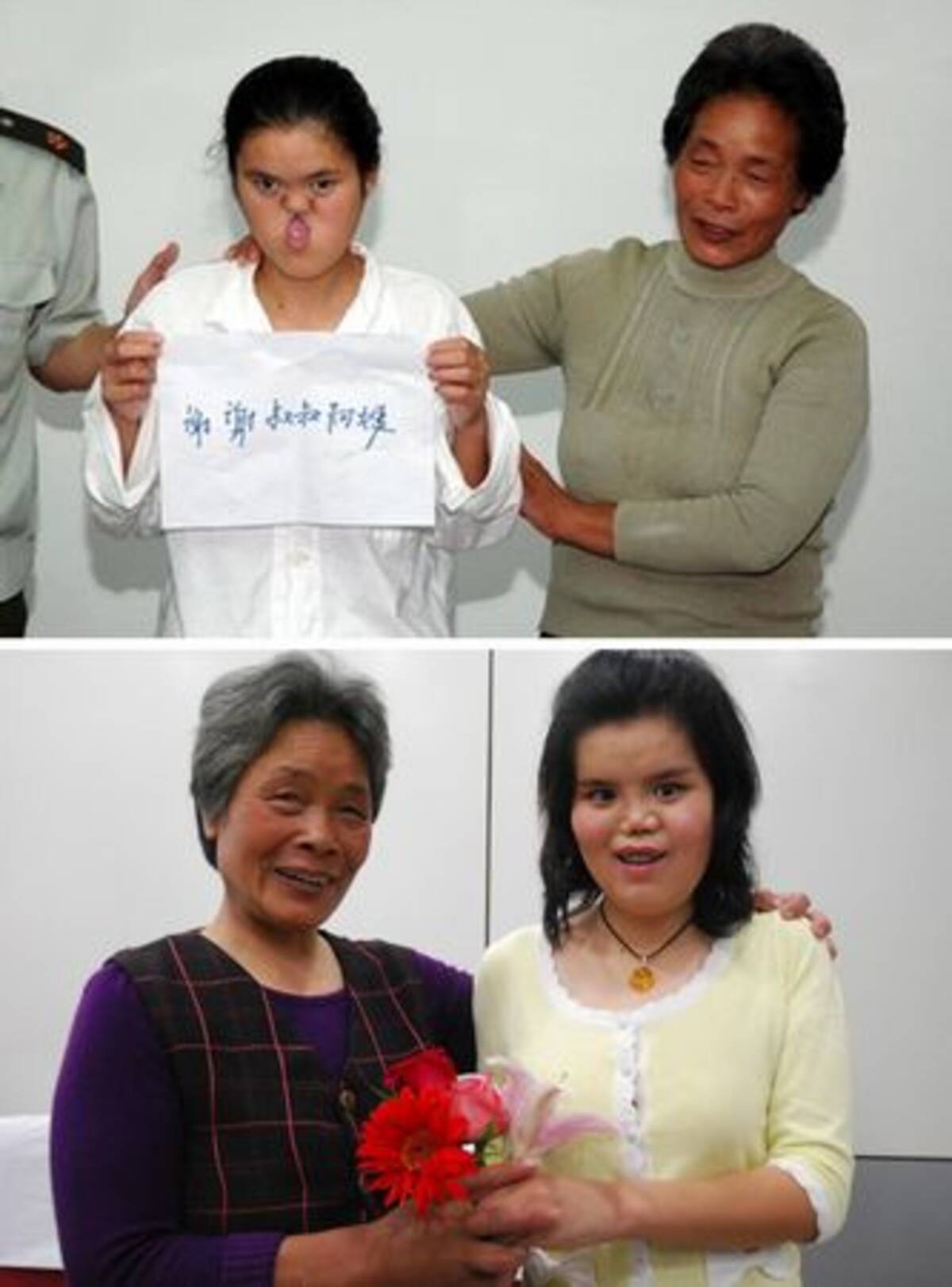 顔面の奇形の整形に成功 22歳の女性が喜びの声 中国 10年5月18日 エキサイトニュース