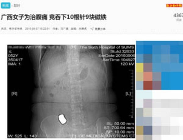 腹痛が治る を鵜呑みにした中国の女性 針と磁石を飲み込み緊急手術 中国メディア 15年9月9日 エキサイトニュース