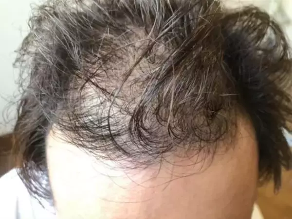 「20代前半のころ「薄毛を隠していた」男性が、“隠さなくなってから”気づいたこと――仰天ニュース特報」の画像