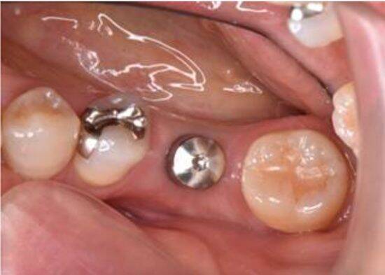 高額な“インプラント”を抜くはめに…歯医者が明かす、インプラント治療の“落とし穴”――大反響セレクション