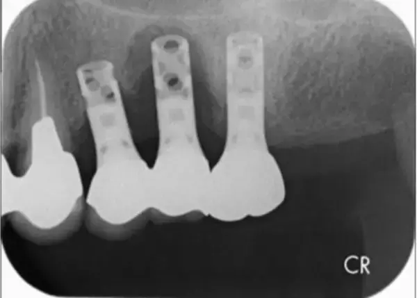 「高額な“インプラント”を抜くはめに…歯医者が明かす、インプラント治療の“落とし穴”――大反響セレクション」の画像