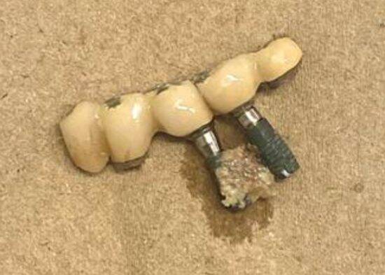 高額な“インプラント”を抜くはめに…歯医者が明かす、インプラント治療の“落とし穴”――大反響セレクション