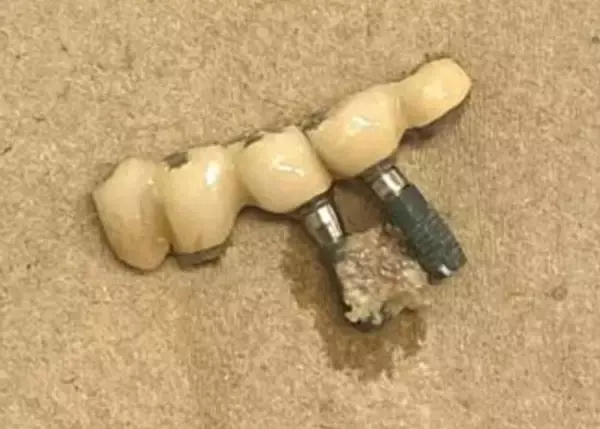 「高額な“インプラント”を抜くはめに…歯医者が明かす、インプラント治療の“落とし穴”――大反響セレクション」の画像