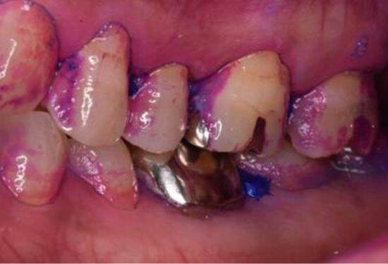 歯医者が断言！“フロス・歯間ブラシをしない人”が10年後に後悔するワケ