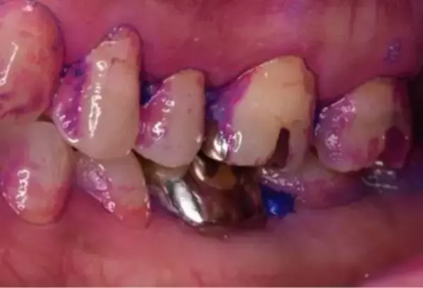 「歯医者が断言！“フロス・歯間ブラシをしない人”が10年後に後悔するワケ」の画像