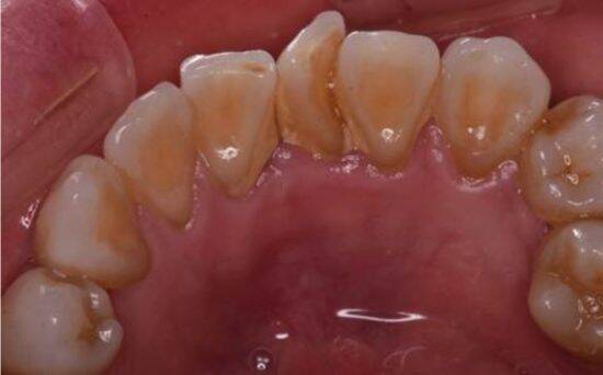 歯医者が断言！“フロス・歯間ブラシをしない人”が10年後に後悔するワケ