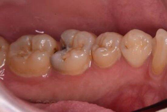 歯医者が断言！“フロス・歯間ブラシをしない人”が10年後に後悔するワケ