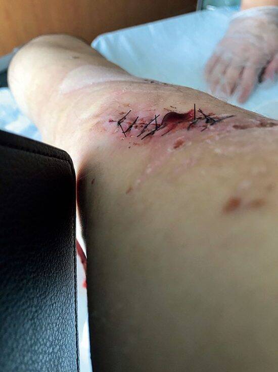 158kgのヒグマに襲われ、全身140針を縫う大けがを負った男性が語る一部始終「最初はクルマにはねられたと…」