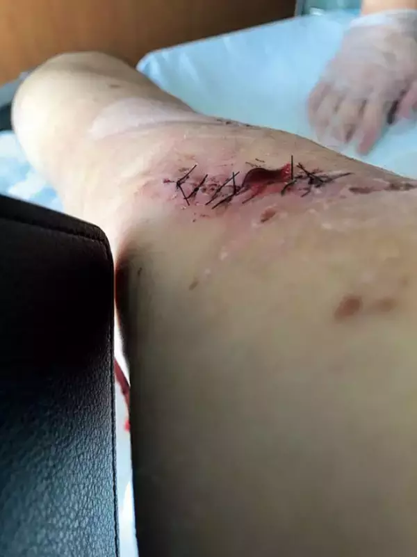 「158kgのヒグマに襲われ、全身140針を縫う大けがを負った男性が語る一部始終「最初はクルマにはねられたと…」」の画像