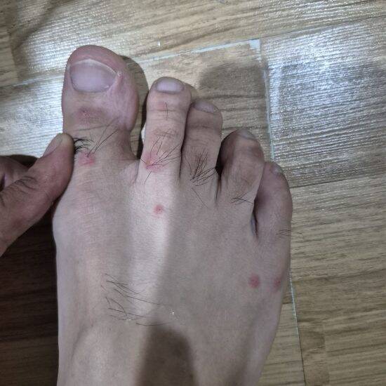 「足に数十匹が…」タイでアリに噛まれた日本人男性が昏倒。全身の蕁麻疹、救急搬送された恐怖の一部始終