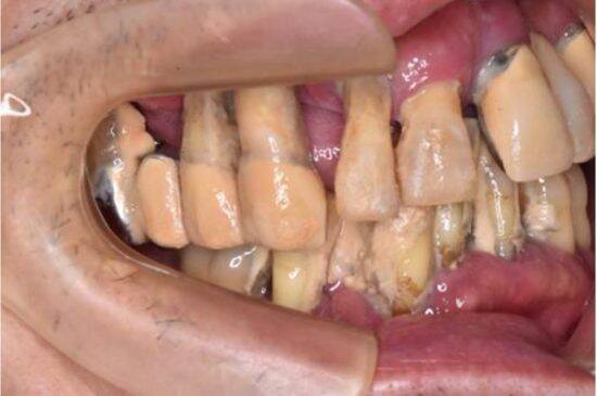 歯科医が警鐘「放置は危険」歯周病の知らないと怖い“全身への悪影響”