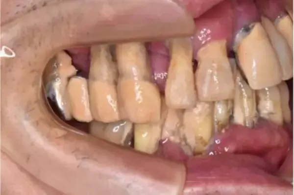 「歯科医が警鐘「放置は危険」歯周病の知らないと怖い“全身への悪影響”」の画像