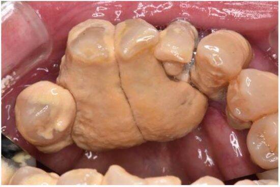 歯科医が警鐘「放置は危険」歯周病の知らないと怖い“全身への悪影響”