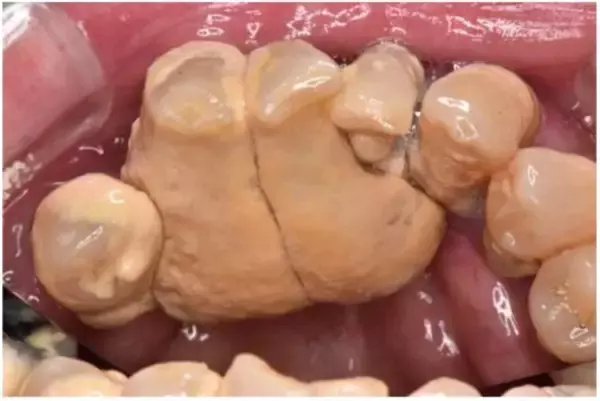 「歯科医が警鐘「放置は危険」歯周病の知らないと怖い“全身への悪影響”」の画像