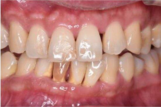 歯を放置するとカラダが壊れる。歯周病が“生活習慣病”を悪化させる意外な理由