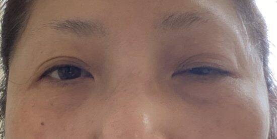 「目の下のくま取り治療が原因で失明しかけた人も」片目縮小、顔がボコボコ…美容整形によるトラブルが急増しているワケ