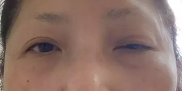 「「目の下のくま取り治療が原因で失明しかけた人も」片目縮小、顔がボコボコ…美容整形によるトラブルが急増しているワケ」の画像