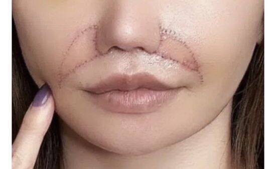 「目の下のくま取り治療が原因で失明しかけた人も」片目縮小、顔がボコボコ…美容整形によるトラブルが急増しているワケ