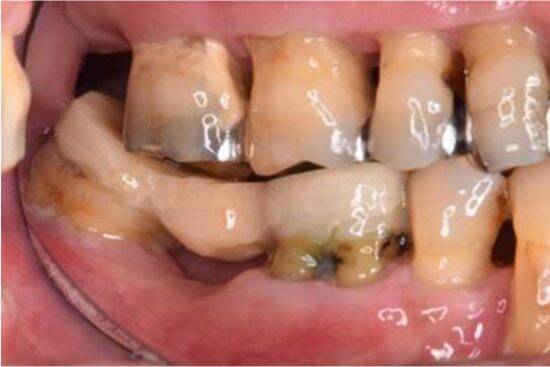 歯医者がむし歯より警戒する“沈黙の病”の怖さ。「まだ大丈夫」を放置すると「高級車1台分のお金を失う」