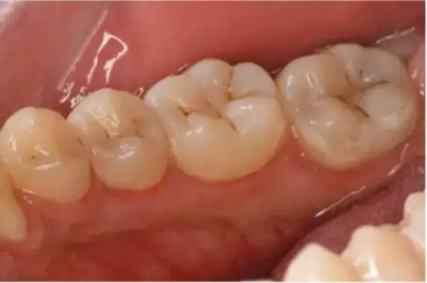 「歯医者がむし歯より警戒する“沈黙の病”の怖さ。「まだ大丈夫」を放置すると「高級車1台分のお金を失う」」の画像