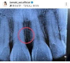 ３４歳フリーアナ　育児中にアクシデント「後頭部がクリーンヒットし…」松平健太の妻・玉木碧アナが明かす