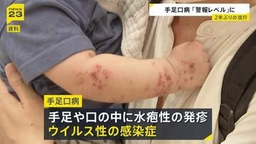 手足口病 2週連続で「警報レベル」1医療機関あたり9.12人　厚労省は手洗いの徹底など呼びかけ