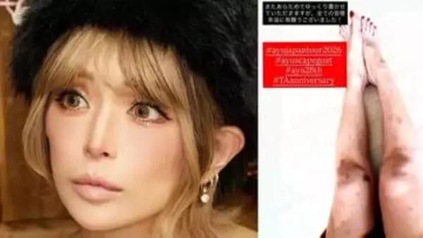 【 浜崎あゆみ 】 「誇らしいでしかない傷だらけの脚」　ツアー開幕直後　〝満身創痍〟な脚を公開　「一緒にツアーの幕開けへ向けて闘い抜いてくれた」