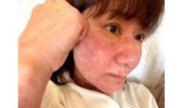 【 がん闘病 】古村比呂さん　突如発症した〝薬アレルギー〟　現況明かす　「赤い肌は明日落ち着きますように」