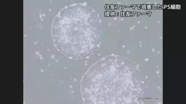 【速報】iPS細胞使ったパーキンソン病患者の再生医療製品「アムシェプリ」 公的医療保険の適用を了承 価格は約5530万円 中医協