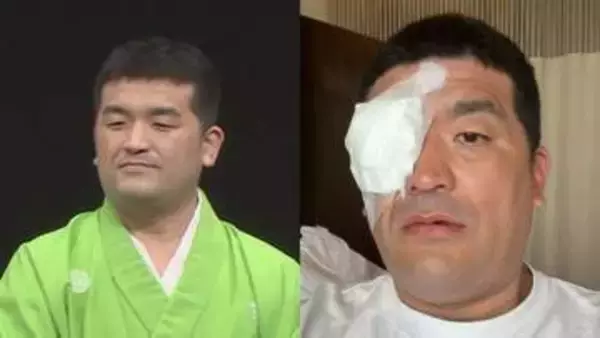 【 すゑひろがりず・三島達矢 】　右目白内障で手術　「手術時間も短く無事に成功」　 SNSに本人明かす　「原因はアトピーの合併症らしく」