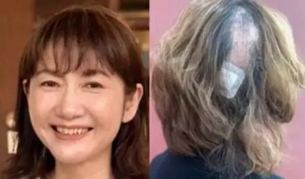 【 がん闘病 】古村比呂さん「頭皮の帯状疱疹になって 髪の毛が部分的にごっそりと抜けてから 約1年」「見事に生えてきました」