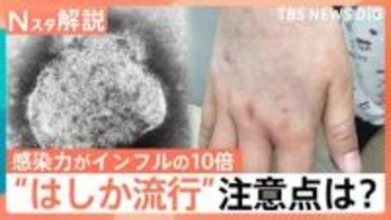 はしか「発症の1日前から感染力」「風邪のような症状のあとに発疹」26～53歳は特に注意！ワクチン接種歴の確認を【Nスタ解説】