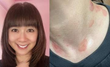 【 白石まるみ 】『多型滲出性紅斑』発症を報告「首の周りとかなんとなく痒くて、今朝、鏡見てびっくり!!」「なんじゃこりゃー!!」