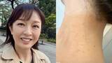 「【 丸岡いずみ 】　人生初の毛虫被害で皮膚炎に　「こんなに痒いのね」　GWのキャンプや露天風呂が原因か」の画像1