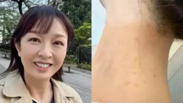 【 丸岡いずみ 】　人生初の毛虫被害で皮膚炎に　「こんなに痒いのね」　GWのキャンプや露天風呂が原因か