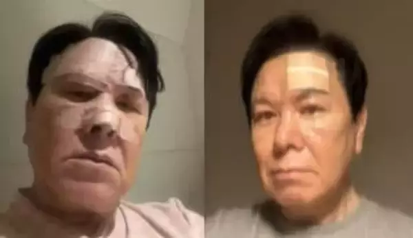 先月、転倒し大けが・鼻を骨折　【 三ツ矢雄二 】 「だんだん回復して来ました。まだ、頭はジンジン痛いけど。おでこの左側にでっかい傷跡が残ってます」　現況を報告