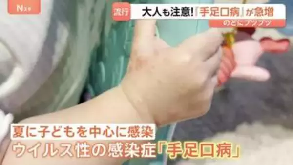 大人も注意「手足口病」急増！のどにプツプツ「痛くて食べられない飲めない」 子育て現場では手洗い徹底＆個別タオル　大人も子どもも引き続き注意が必要